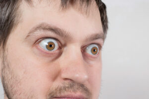 Close-up of a young man with bulging eyes due to thyroid eye disease.